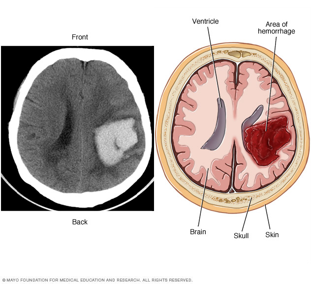 Scan/graphic image of intracerebral hemorrhage